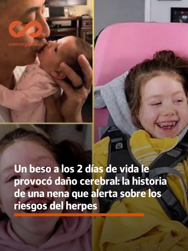 Un beso a los 2 días de vida le provocó daño cerebral: la historia de una nena que alerta sobre los riesgos del herpes.-